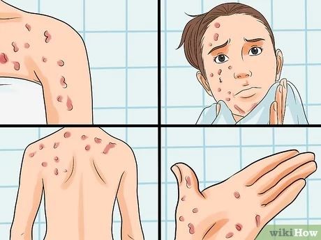 HIV symptoms - HIV body rash